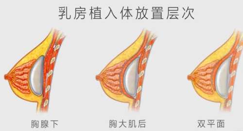 隆胸