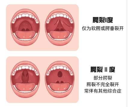 唇腭裂