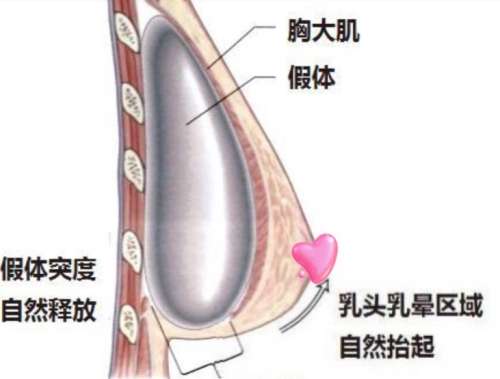 隆胸