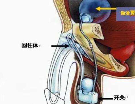 男性私密整形 男性私密整形