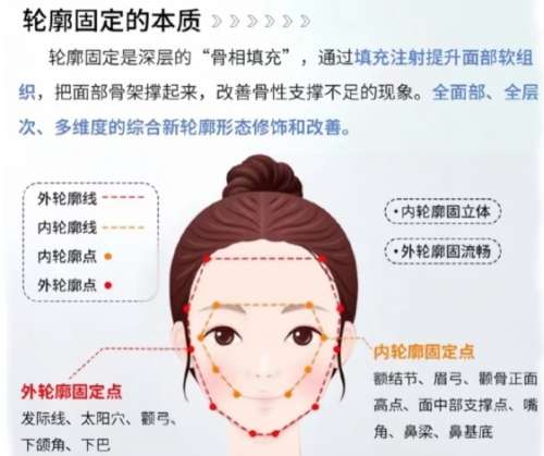 轮廓固定