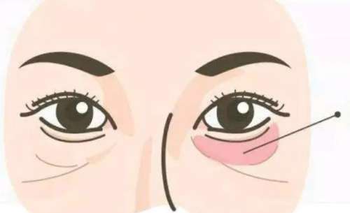 眼袋 眼袋
