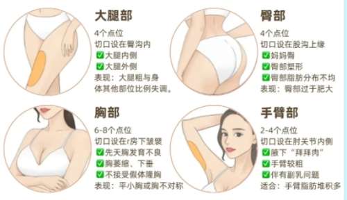 吸脂知识科普jpg
