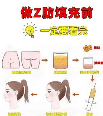 脂肪填充