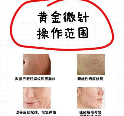 黄金微针