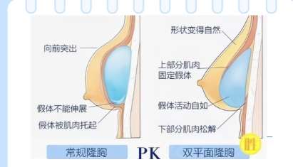 隆胸
