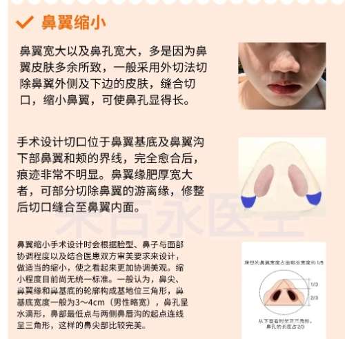 缩鼻翼鼻头图.jpg