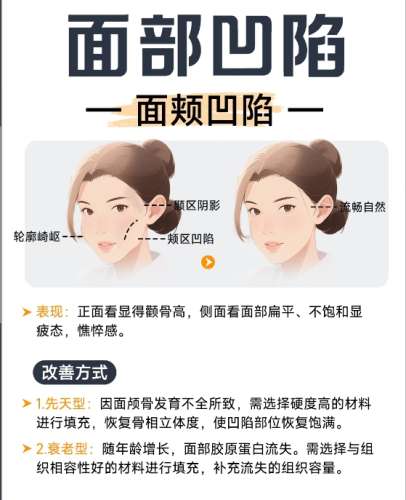 面部填充知识科普jpg.jpg