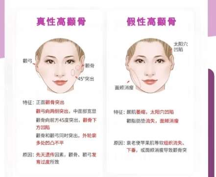 颧骨整形