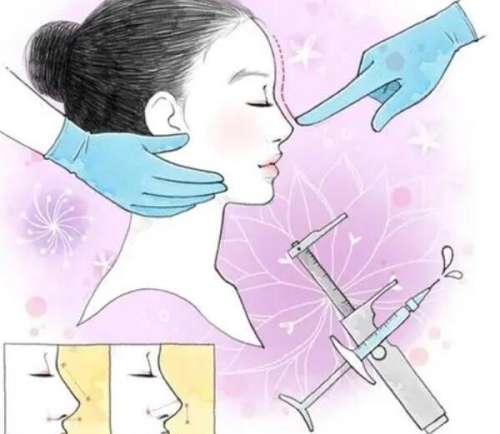 隆鼻