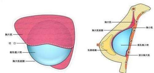隆胸
