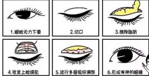 双眼皮
