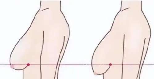 乳房下垂矫正.jpg