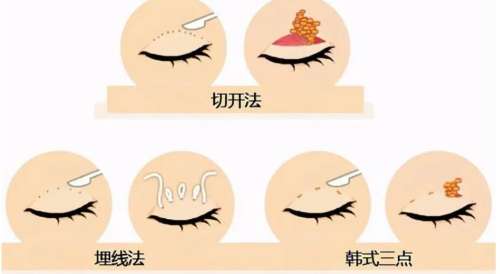 双眼皮