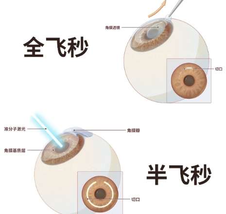 近视眼