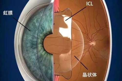 ICL晶体植入术04.jpg