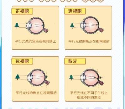 近视眼矫正